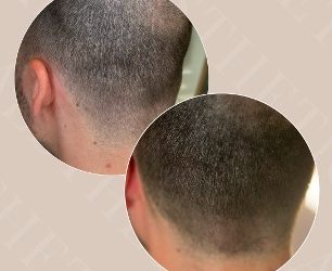 Trichopigmentácia: prírodné riešenie pre rednúce vlasy, jazvy a nerovnomernú hustotu